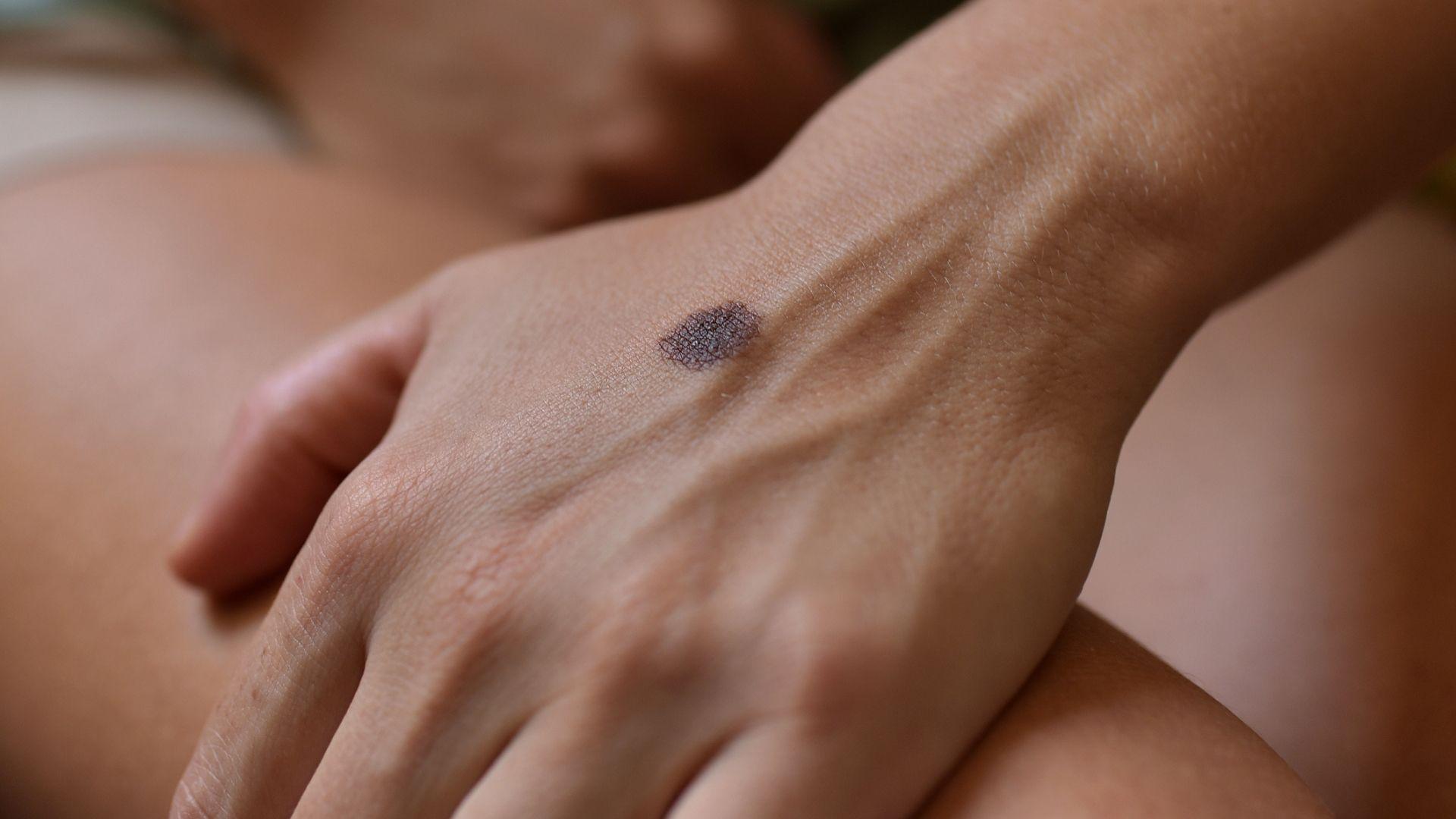 Tumori della pelle:  tra prevenzione e diffusione